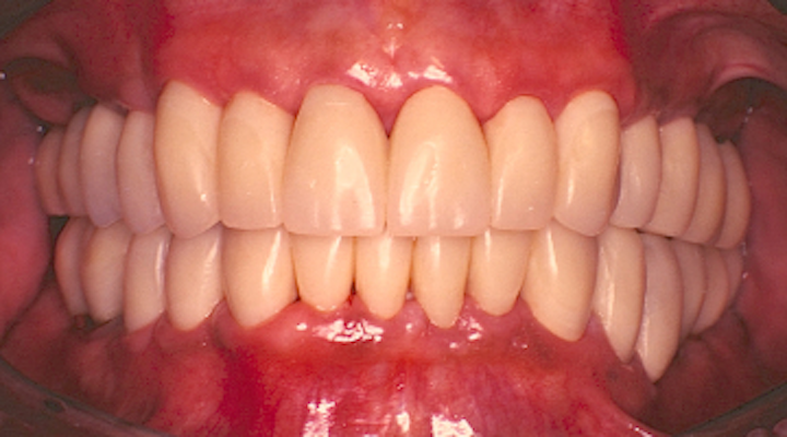Temporaries Versus Provisionals An Important Distinction Perio Implant Advisory