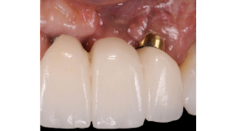 Gerd The Uncomfortable Facts About Holiday Eating Perio Implant Advisory