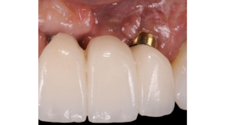 Treatment Of Exposed Dental Implant Surfaces With The Minimally Invasive Bone Grafting Technique Smart Perio Implant Advisory This method is great for economical, shorten, or limited scions from mother plant. treatment of exposed dental implant