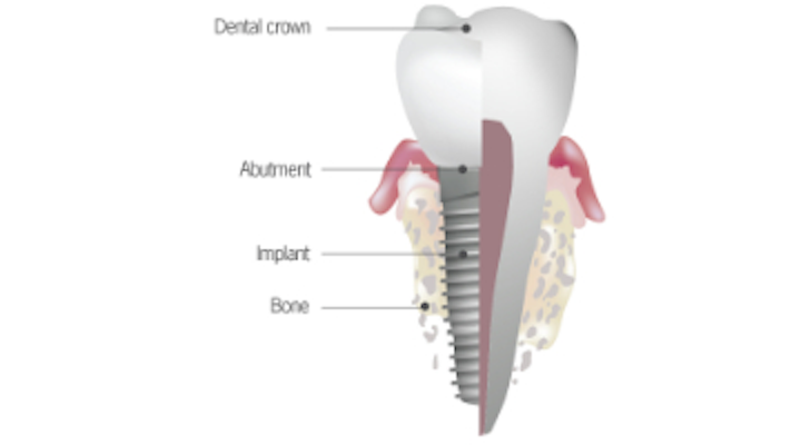 Top 5 Anatomical Differences Between Dental Implants And Teeth That Influence Treatment Outcomes Perio Implant Advisory