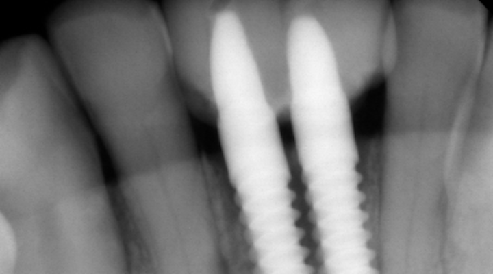 Narrow Diameter Implants A Solution For Replacing Single Missing Lower Incisors Perio Implant Advisory
