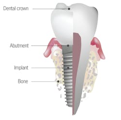Tooth Dental Implant Illustration Tooth Dental Implant Illustration
