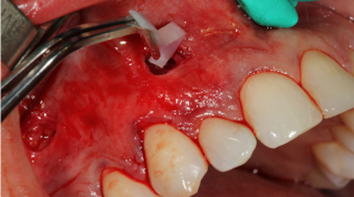 Pinhole Surgical Technique The Rebirth Of The Noninvasive Soft Tissue Graft Perio Implant Advisory