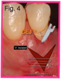 17dec14piabernottip04b 17dec14piabernottip04b