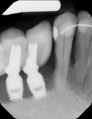 Which Is Most Effective For The Treatment Of Peri-implantitis ...