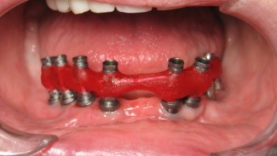 Figure 1: The purpose of an implant verification jig is to mimic the fit of the final frame. A verification jig allows you to verify the accuracy of the model and ensure an accurate final frame every time.