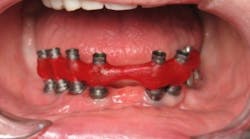 Figure 1: The purpose of an implant verification jig is to mimic the fit of the final frame. A verification jig allows you to verify the accuracy of the model and ensure an accurate final frame every time. Figure 1: The purpose of an implant verification jig is to mimic the fit of the final frame. A verification jig allows you to verify the accuracy of the model and ensure an accurate final frame every time.