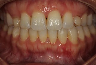 Figure 1: Stage I periodontitis