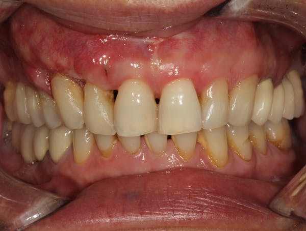 Figure 2: Stage II periodontitis