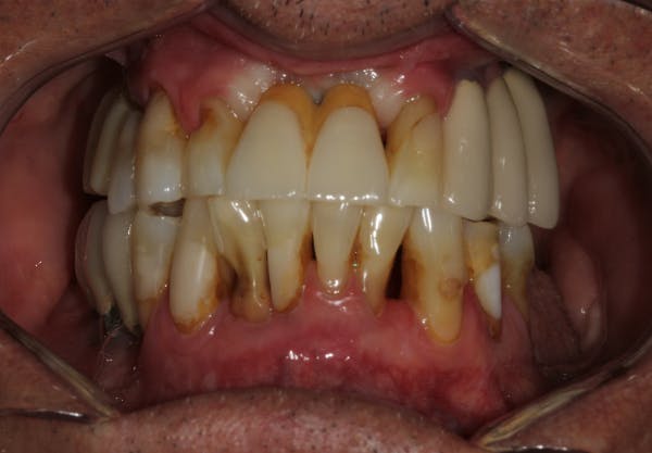 Figure 3: Stage III periodontitis