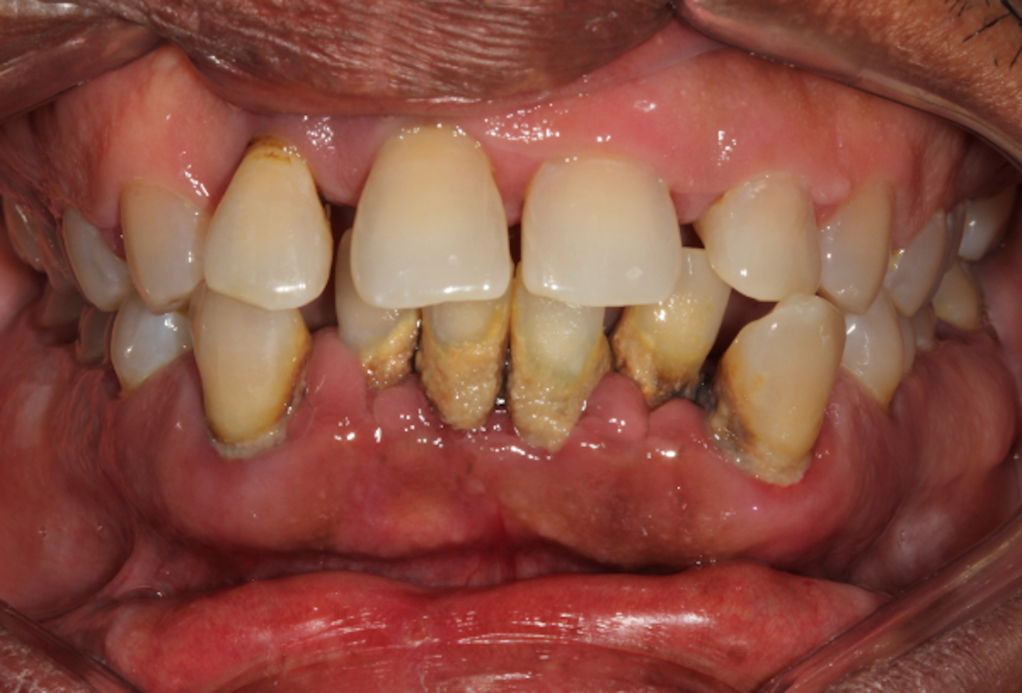 The new classification of periodontal disease that you, your patient