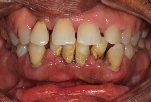 Figure 4: Stage IV periodontitis