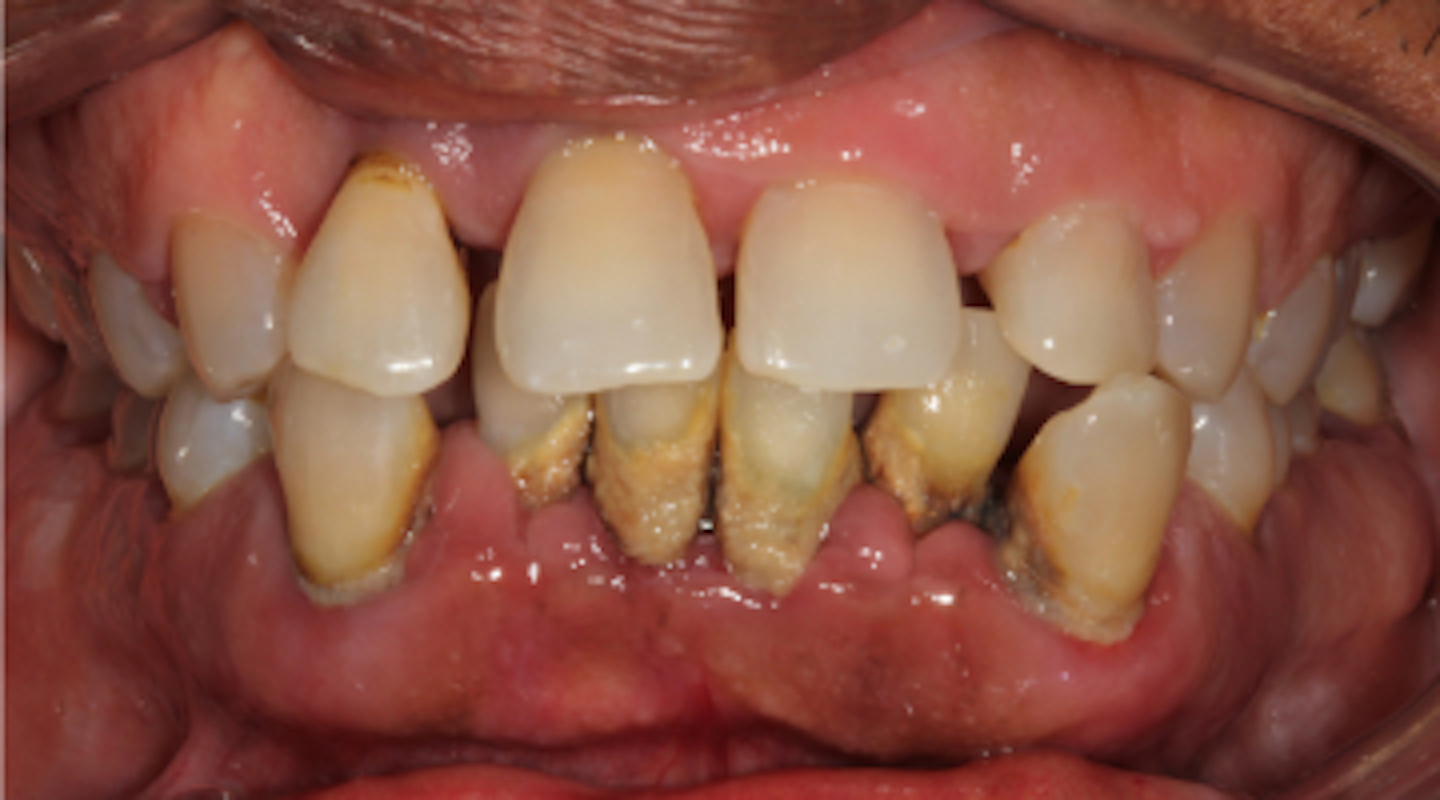 The new classification of periodontal disease that you, your patient