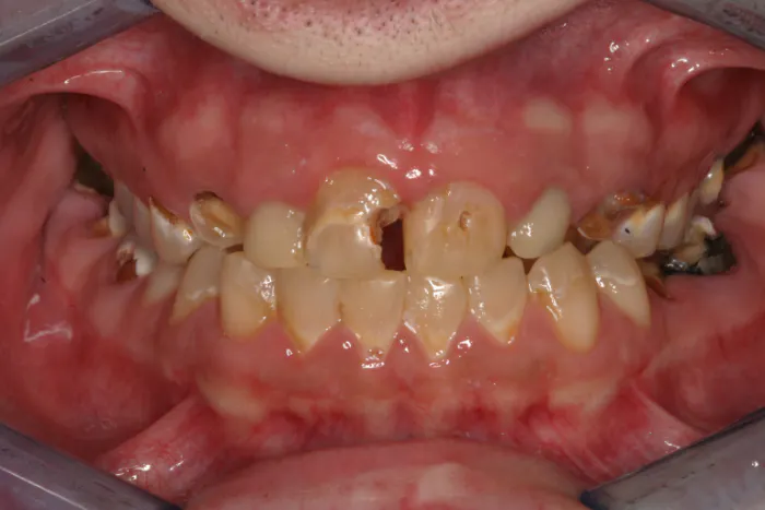 cigarette effects on teeth How Does Smoking Damage Teeth? Our dentist in Armadale shares