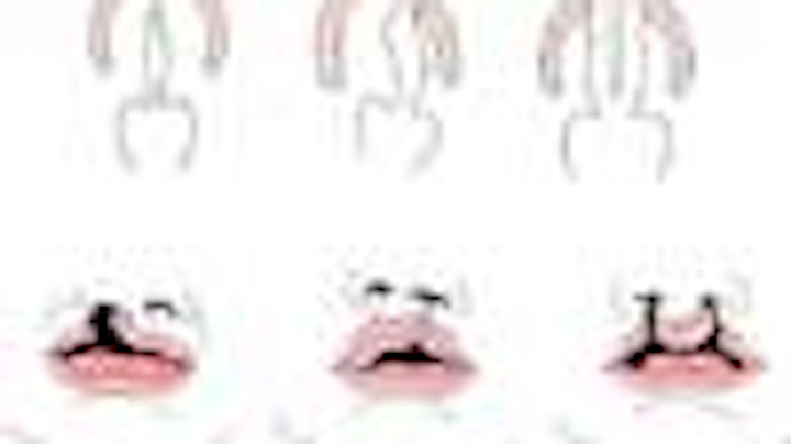 Content Dam Diq Online Articles 2014 09 Cleft Lip Palate Thumbnail