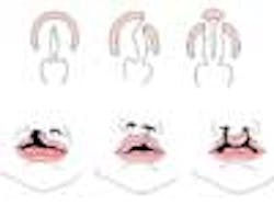 Content Dam Diq Online Articles 2014 09 Cleft Lip Palate Thumbnail Content Dam Diq Online Articles 2014 09 Cleft Lip Palate Thumbnail