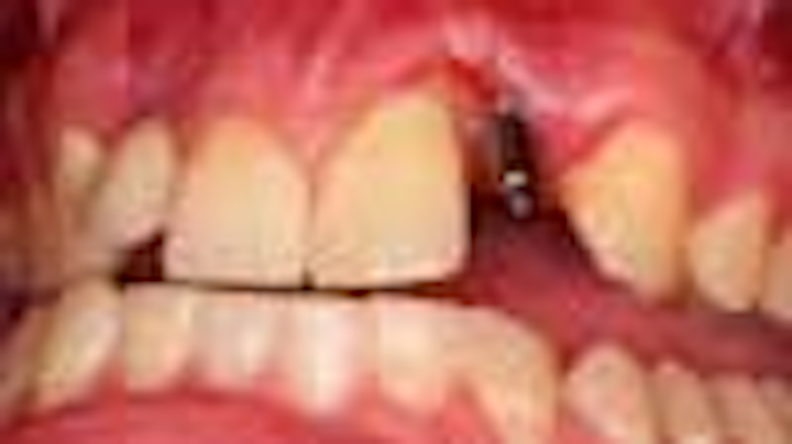 Content Dam Diq Online Articles 2014 11 Kephart Implant Thumbnail