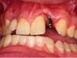 Content Dam Diq Online Articles 2014 11 Kephart Implant Thumbnail Content Dam Diq Online Articles 2014 11 Kephart Implant Thumbnail