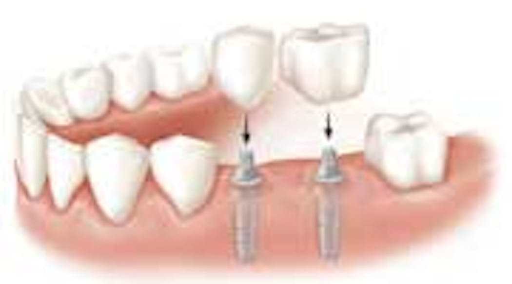 Content Dam Diq Online Articles 2014 12 Dental Implants Ao Jomi Srr Brownfield Thumbnail