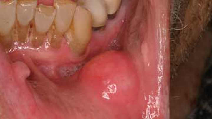 Content Dam Diq Online Articles 2015 05 15may28srrfroum Oralcancer Article Thumbnail