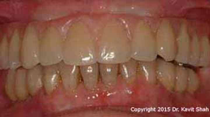A Unique Method Of Debriding A Full Arch Maxillary Prosthesis Supported By Dental Implants Perio Implant Advisory