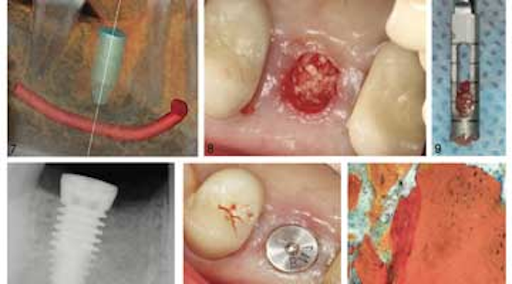 Barrier Aids Bone Regrowth After Socket Grafting Perio Implant Bone Regrowth After Socket Grafting
