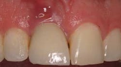 Content Dam Diq Online Articles 2015 09 15sept17pia Clinicaltip Froum Article Thumbnail Content Dam Diq Online Articles 2015 09 15sept17pia Clinicaltip Froum Article Thumbnail