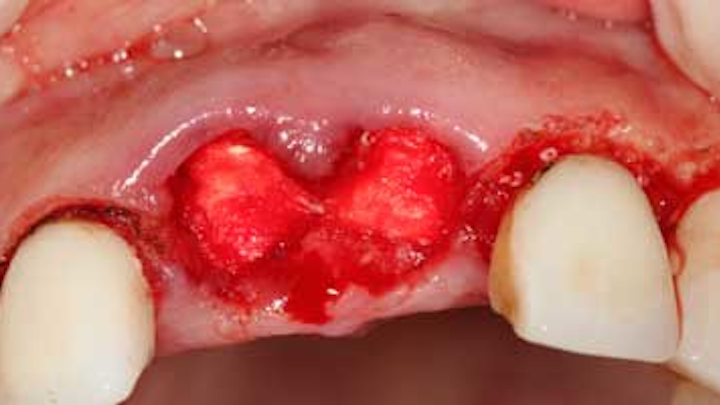 Content Dam Diq Online Articles 2015 11 15nov17pia Jacob Hemostasis Article Thumbnail