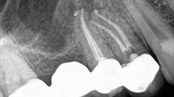 Content Dam Diq Online Articles 2015 11 Nonsurg Endo Cbct Mccormack Thumb Content Dam Diq Online Articles 2015 11 Nonsurg Endo Cbct Mccormack Thumb