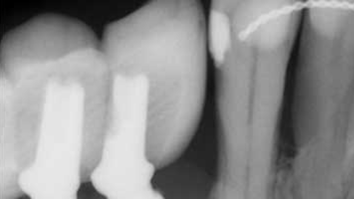 Content Dam Diq Online Articles 2015 11 Peri Implant Bone Loss Scott Froum Article Thumb