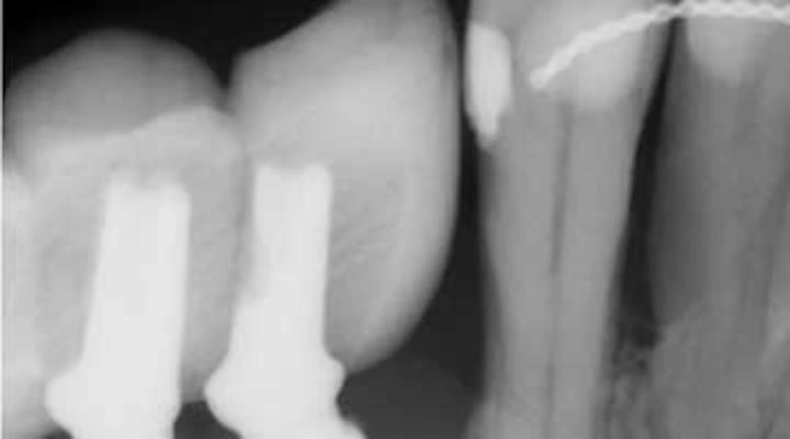 Understanding And Managing Peri Implant Bone Loss Perio Implant Advisory