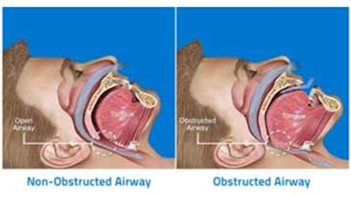 Content Dam Diq Online Articles 2015 11 Sleep Apnea Occlusal Guards Sadri Thumb