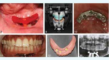 Content Dam Diq Online Articles 2016 01 Joi Implants Help Leg Bone Replace Jawbone Article Thumb