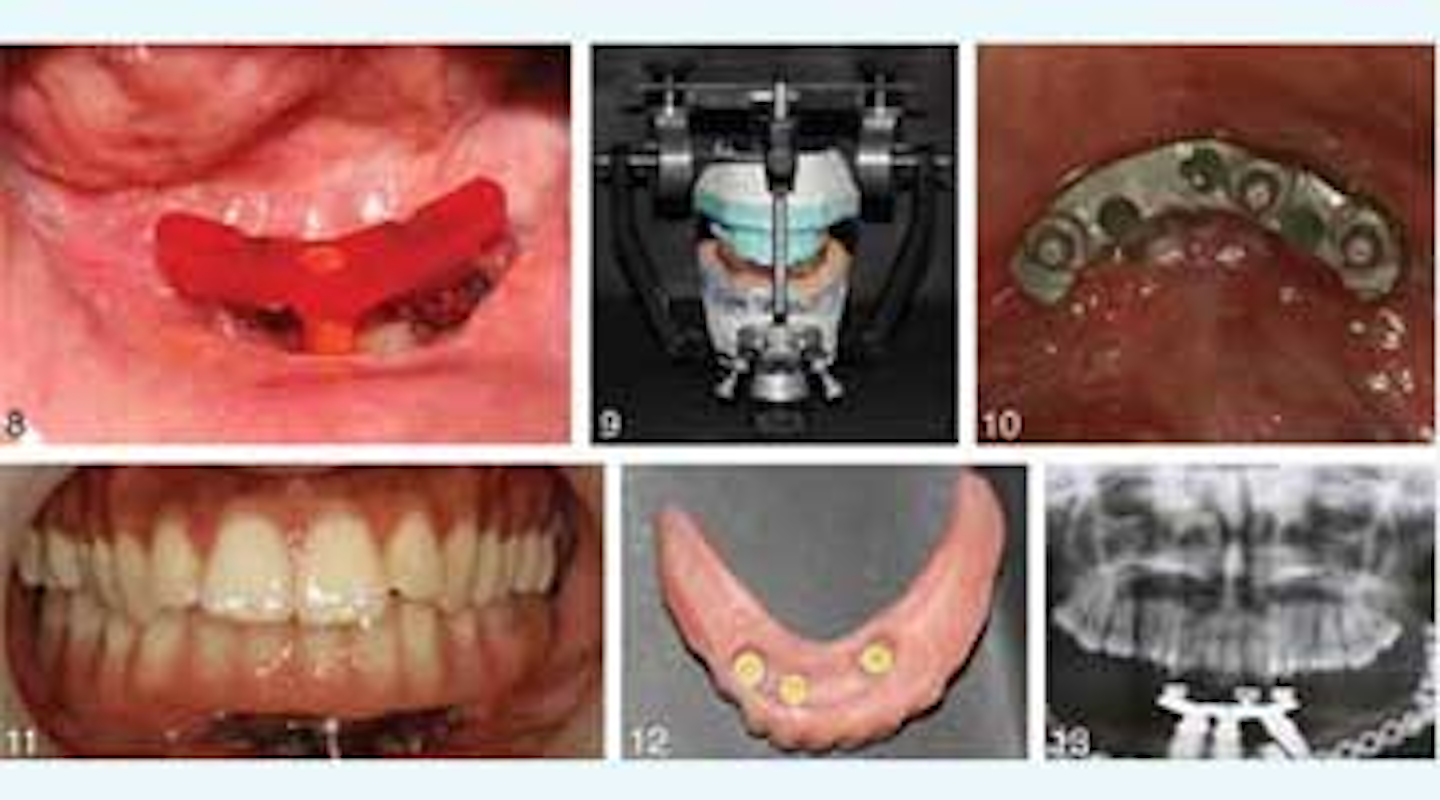 Dental implants help leg bone successfully replace jawbone PerioImplant Advisory