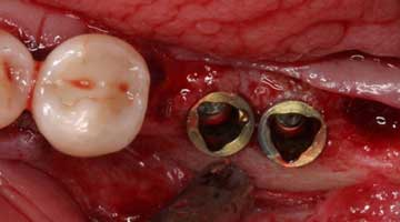 dental implants gone wrong