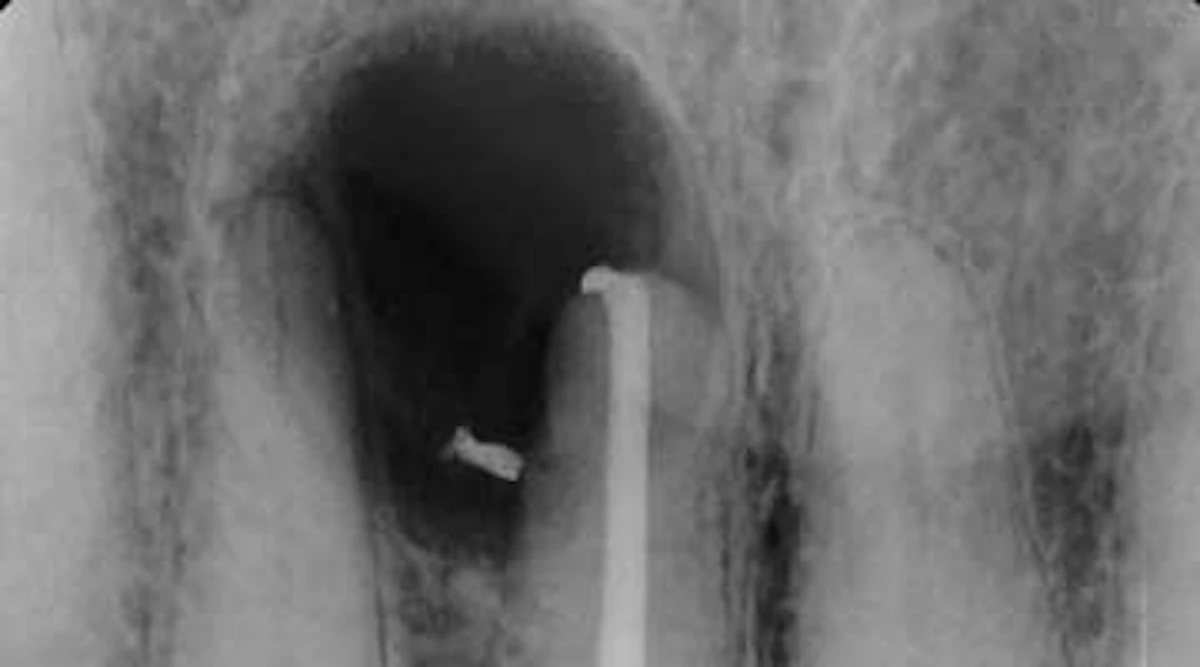 Postextraction Treatment Did Your Bone Graft Fail Or Did You Fail Your Bone Graft Perio Implant Advisory