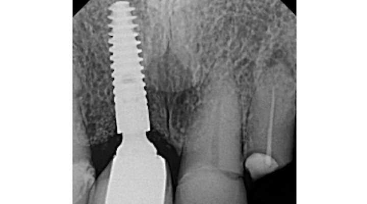 Top Factors Leading To Dental Implant Abutment Implant Fixture Misfit The Dreaded Macrogap Perio Implant Advisory