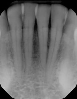 Figure 1 Vaping Oral Health Dentistry Figure 1 Vaping Oral Health Dentistry