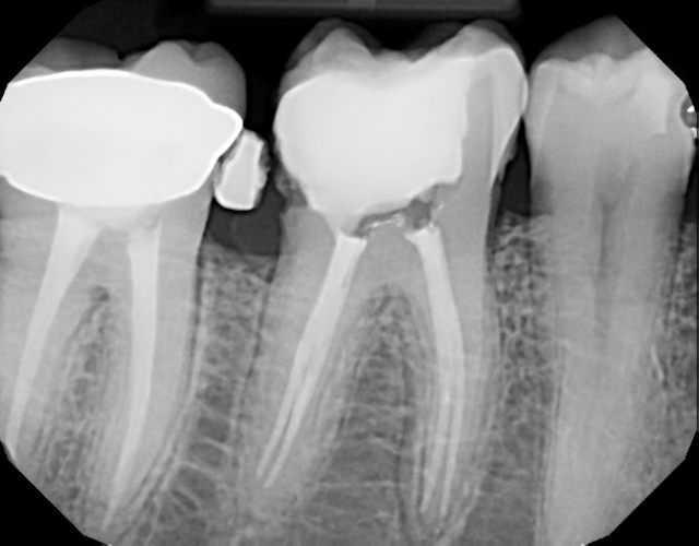 Bad Root Canal Xray - Root Canal Toothache