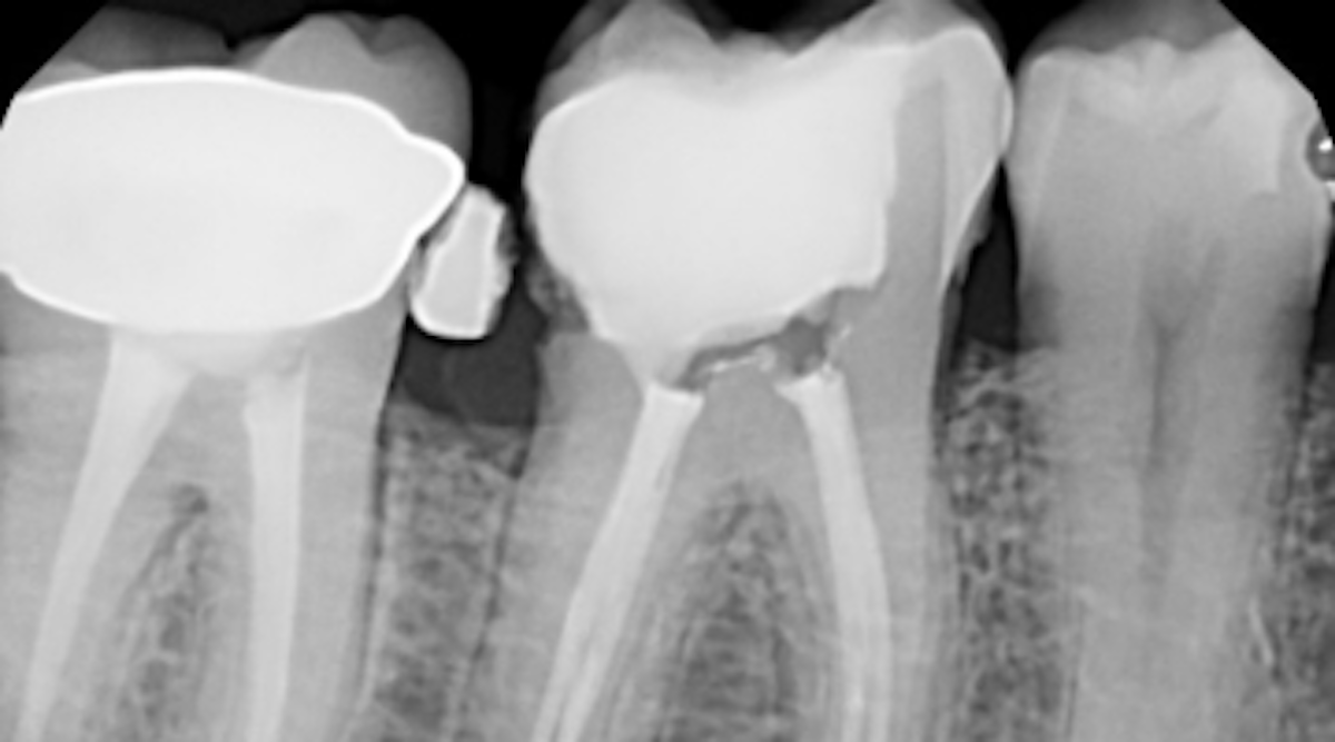 Do root canals cause cancer? | Perio-Implant Advisory