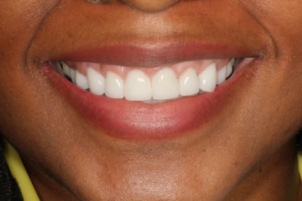 Considerations When Using Veneers To Fabricate A Perfect Smile Considerations When Using Veneers To Fabricate A Perfect Smile
