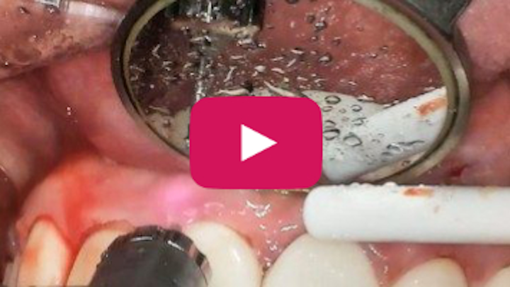 Content Dam Sr En Articles 2018 03 Functional Crown Lengthening Around Bleeding Crown And Veneer Restorations Leftcolumn Article Thumbnailimage File