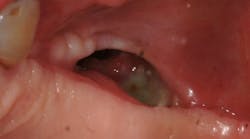 Content Dam Sr En Articles 2018 12 Maxillary Sinus Grafting Prevention And Management Of Complications Leftcolumn Article Thumbnailimage File Content Dam Sr En Articles 2018 12 Maxillary Sinus Grafting Prevention And Management Of Complications Leftcolumn Article Thumbnailimage File