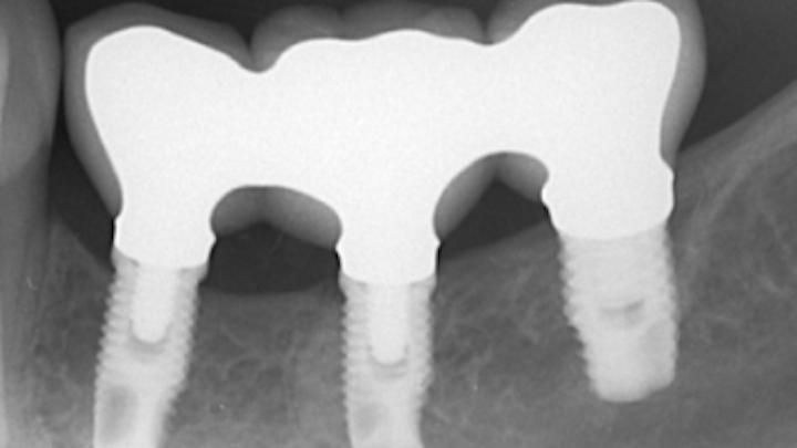 Content Dam Sr En Articles 2019 01 To Splint Or Not To Splint Adjacent Implants A 10 Year Retrospective Analysis Leftcolumn Article Thumbnailimage File