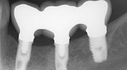 Content Dam Sr En Articles 2019 01 To Splint Or Not To Splint Adjacent Implants A 10 Year Retrospective Analysis Leftcolumn Article Thumbnailimage File Content Dam Sr En Articles 2019 01 To Splint Or Not To Splint Adjacent Implants A 10 Year Retrospective Analysis Leftcolumn Article Thumbnailimage File