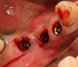 Figure 1: When screw fractures occur in the coronal third of the dental implant chamber, artery forceps, explorers, spoon excavators, and Cavitrons are useful for screw retrieval. Figure 1: When screw fractures occur in the coronal third of the dental implant chamber, artery forceps, explorers, spoon excavators, and Cavitrons are useful for screw retrieval.