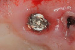 Figure 2: A solution for screw retrieval using a high-speed handpiece. See procedure steps outlined above. Figure 2: A solution for screw retrieval using a high-speed handpiece. See procedure steps outlined above.