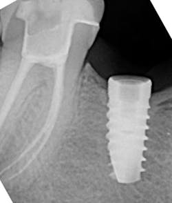 Figure 4: A broken implant screw fractured in the apical 50% of the implant chamber Figure 4: A broken implant screw fractured in the apical 50% of the implant chamber