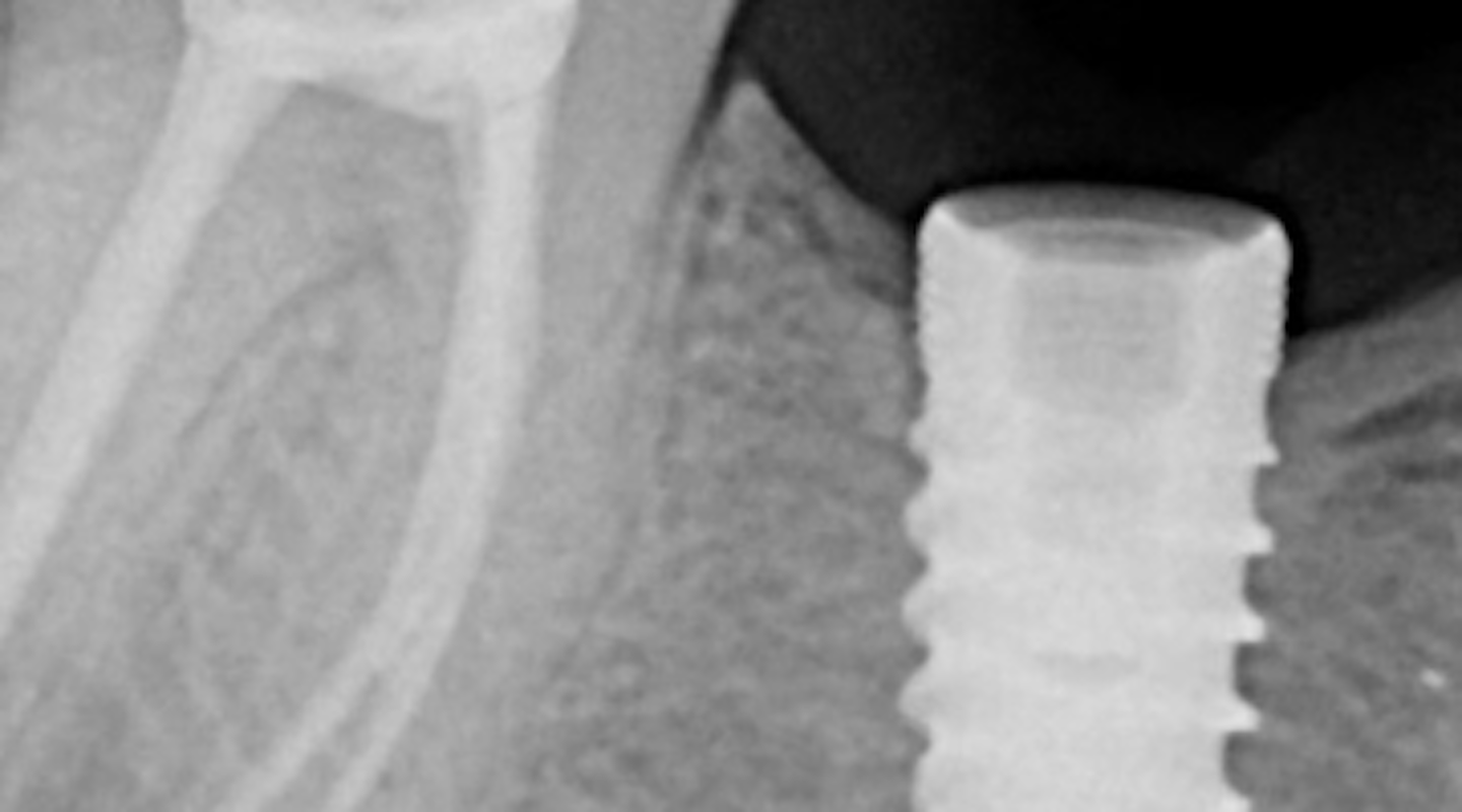 Fractured dental implant screw complications 3 methods for screw