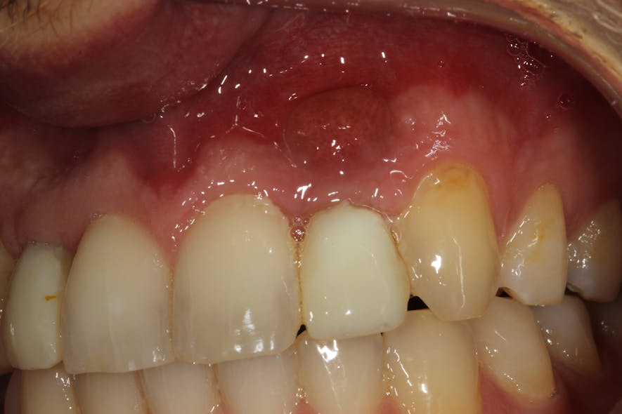 Figure 2a: Abscess at the apex of implant No. 10 placed two years ago. The tooth was removed, and the site was not preserved with graft material. The implant was placed six months after tooth removal.